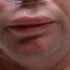 angioedema_pic angioedema_pic
