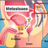 metastatic-prostate-cancer