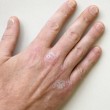nail psoriasis