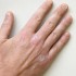 nail-psoriasis nail psoriasis