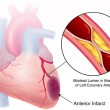 Acute Myocardial Infarction Acute myocardial infarction biomarkers