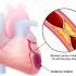 Acute myocardial infarction biomarkers