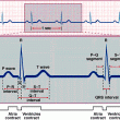 Normal EKG Normal EKG