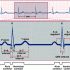 Normal EKG Normal EKG