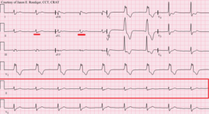 AIVR Accelerated Idioventricular Rhythm
