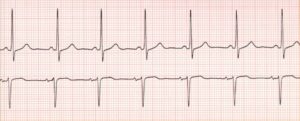 Normal Sinus Rhythm