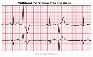 PVCs