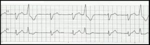 Trigeminy PVC